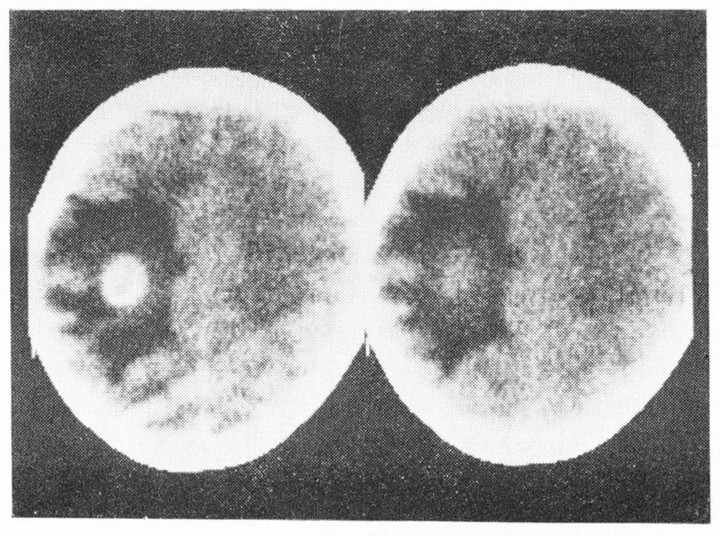 SUMMARY Cerebral cysticercosis as a mass lesion: