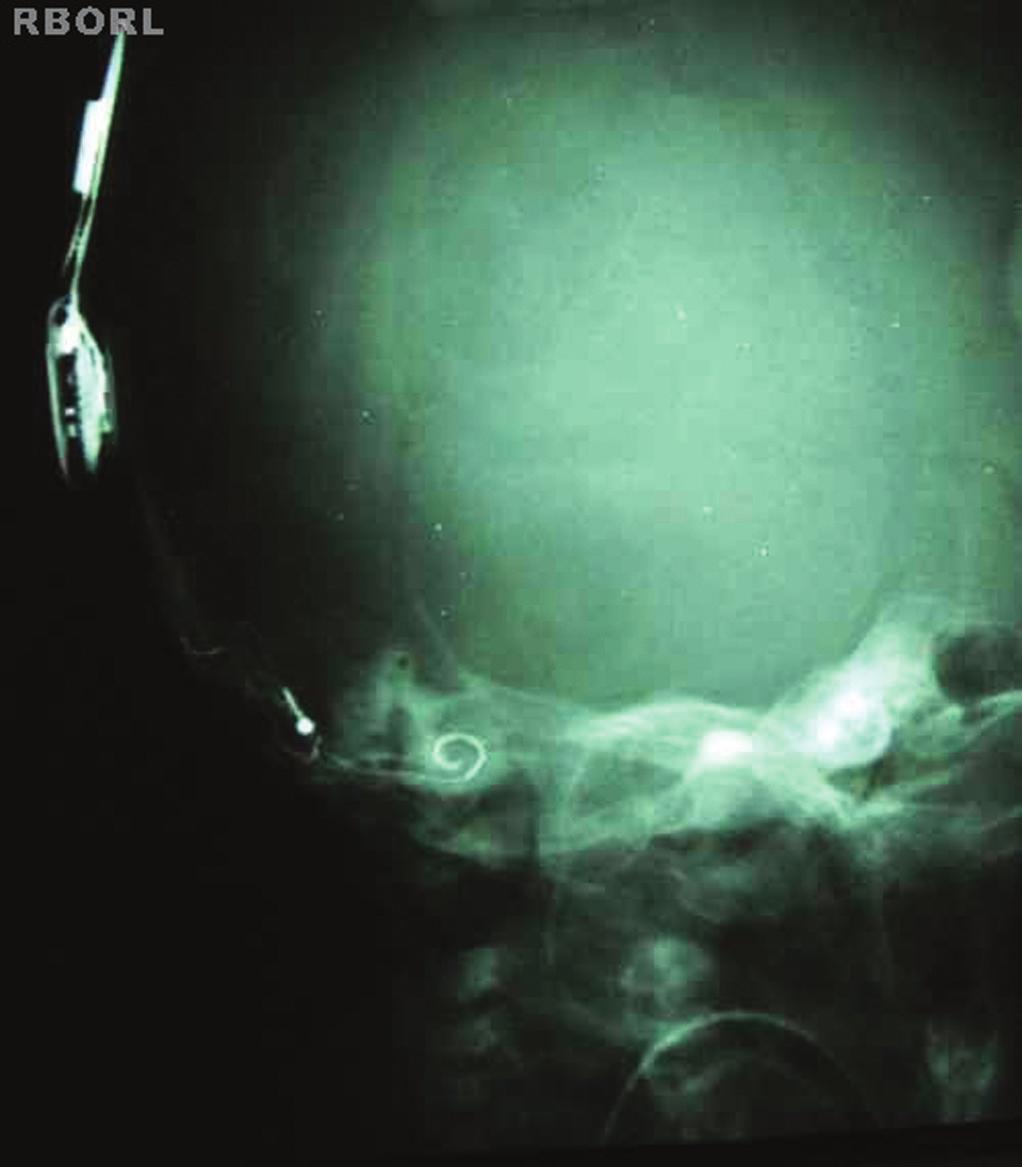 Resultado radiológico esperado Uma imagem posicionada corretamente demonstrará o seguinte: Côndilo mandibular superposto à coluna cervical. Labirinto ósseo abaixo da crista petrosa.