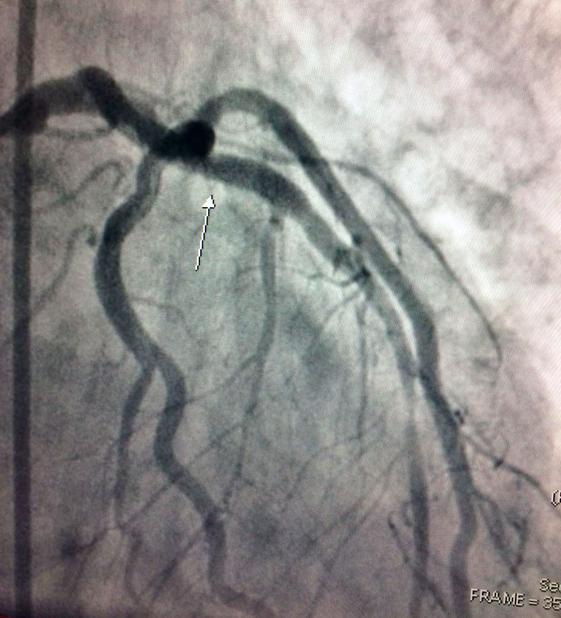 Fig. 4 Pós tratamento com stent convencional Evoluiu a partir dai com melhora significativa do estado clinico, estável hemodinamicamente e sem novos episódios de arritmia.