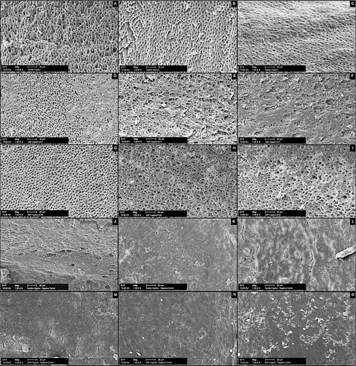 Fig 1- Imagem da presença de smear layer obtida através de SEM (Kato, Augusto Shoji, 2014).