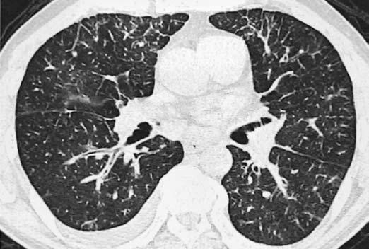 : Reformatação coronal evidencia espessamento septal interlobular liso difuso, bem como alguns do tipo nodular (seta branca).