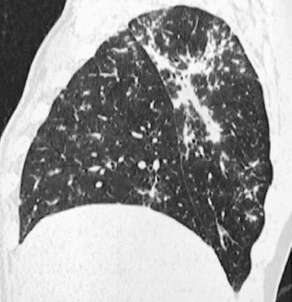 : TCR em multidetector (corte axial) ao nível dos campos pulmonares médios revela linfonodomegalia hilar bilateral e simétrica, associada a numerosos pequenos nódulos distribuídos pelo interstício