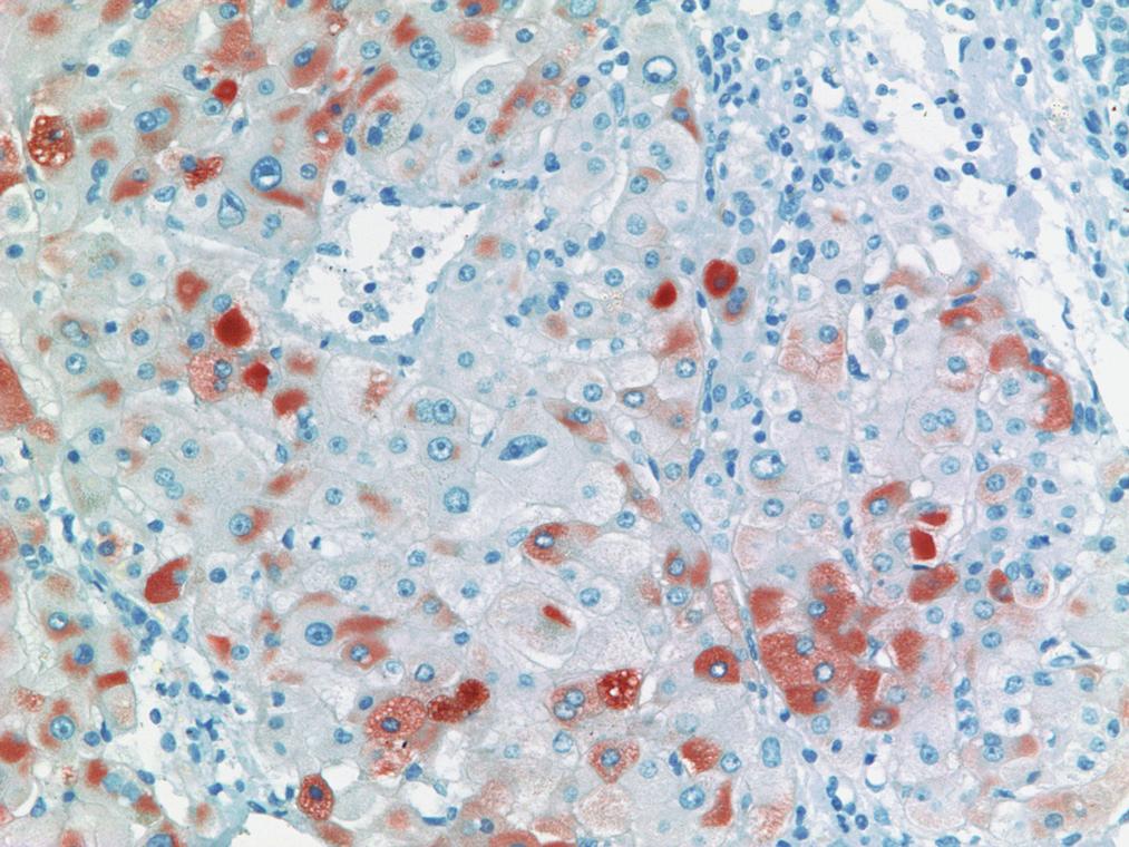 5 Hepatite C crônica com inflamação portal e hepatite de interface