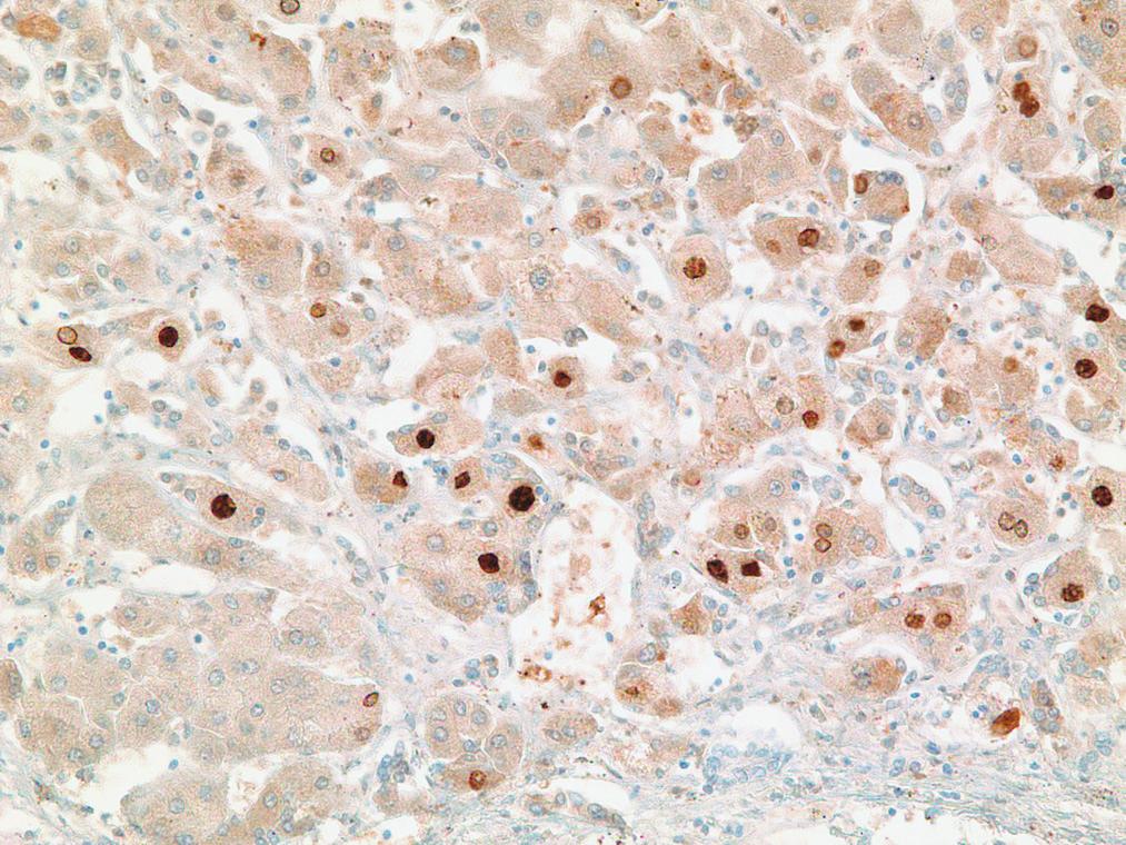 mononucleares infiltrantes) (H&E, ampliado 20x). Figura e38.