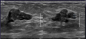 Elastografia Shear-wave MAMA IMAGEM Elastografia Shear-wave MAMA IMAGEM