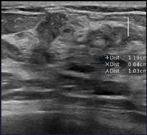 Elastografia Shear-wave