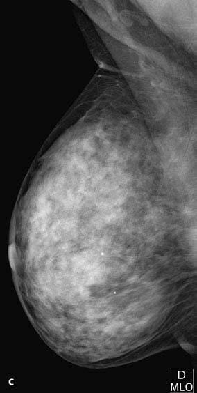 Mamografia: Projeção Mediolateral Oblíqua 1 Métodos c Mamografia MLO direita. O mamilo não é visualizado de perfil, prega cutânea abdominal.