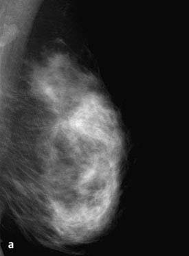 Mamografia: Compressão Localizada 1 