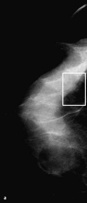 Mamografia: Mamografia Ampliada 1 Métodos b Mamografia ampliada de a.