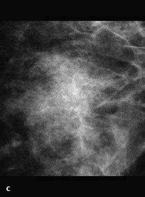 1Métodos Mamografia: Mamografia Ampliada c Microcalcificações