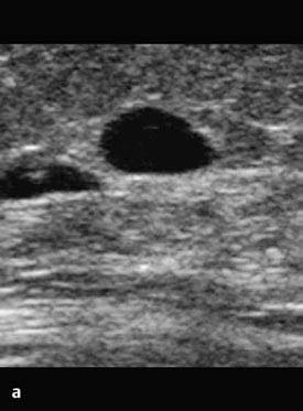 1Métodos Ultrassonografia Fig. 1.1a-d Ultrassonografia. a Cisto complicado com massa hiperecoica intraluminal na margem superior. b Fibroadenoma.