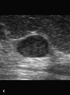 Ultrassonografia 1 c Papiloma.