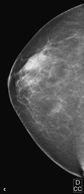 1Métodos Mamografia: Projeção Craniocaudal c Mamografia craniocaudal direita.
