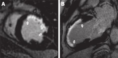 112 Massa infartada do VE pela ressonância magnética prática para a determinação da extensão do infarto.