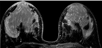 interpretando estudos de MR de mama devem estar familiarizados com os padrões de realce normais do tecido mamário