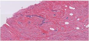 fibrocísticas Fibrose estromal Fibroadenoma Adenose Esteatonecrose Metaplasia apócrina Hemagioma Alto