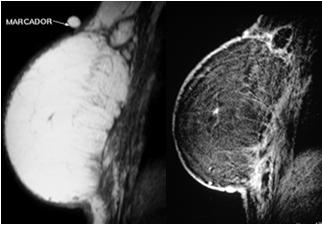 2008;191:1374 1380 Esteatonecrose - MRI Nódulo