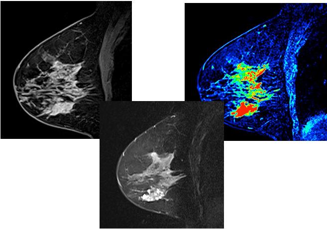 Adenose Proliferação de ductos com hipertrofia das células epiteliais e discreta hiperplasia, do revestimento ductal RM