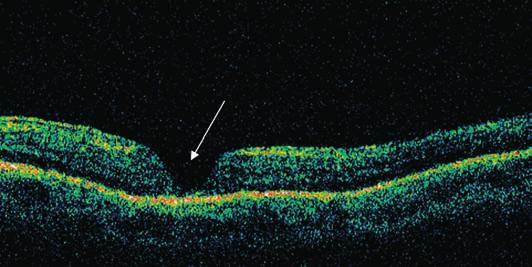 O OCT evidenciou uma retina aplicada e um cisto perifoveal de 215 µm (Figura 4).