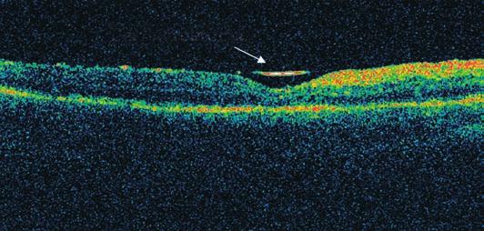 Caso 6 ETA, sexo feminino, 46 anos, com baixa de acuidade visual progressiva há 10 meses e piora súbita há 5 dias. Apresentando DR total, foi submetida a vitrectomia com implante de óleo de silicone.