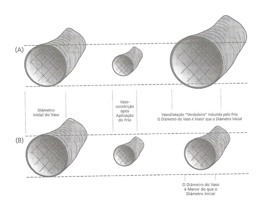 A: Diametro Normal do vaso; vasoconstrição com aplicação do gelo, Vasodilatação Induzida pelo Frio. Calibre final > inicial.