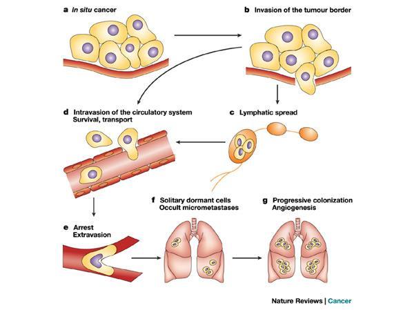 Fisiopatologia do Câncer Com características invasivas as células têm alterações em tecidos circunvizinhos, tendo,