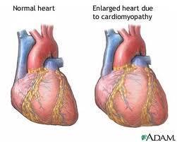 Insuficiência Cardíaca Ocorre quando os ventrículos não conseguem bombear sangue para o corpo.