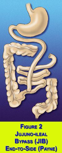 Fundamentação Teórica 24 terminolateralmente. O restante do intestino delgado permanece fora do trânsito alimentar, reduzindo drasticamente a superfície absortiva (13).