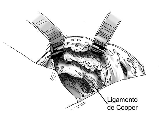 CASUÍSTICA E MÉTODO 66 FIGURA 8 Incisão de Pfannenstiel. FIGURA 9 Ligamentos de Cooper.