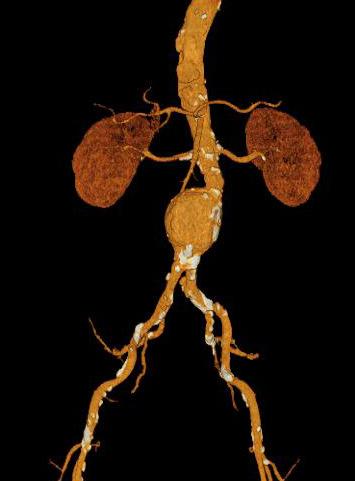 40 de morte nos EUA. Segundo os pesquisadores Raghavan, Marshall Webster e David Vorp (1996) de 3% a 5% da população mundial sofre de aneurisma da aorta abdominal (AAA). Na figura 2.