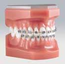 Ortodontia 38 E 90 Bracket metálico BIONIC TM DentaLeader, o nº 1 dos melhores preços 99 E Um caso, caixa com 20 Brackets 5 x 5 U/L sem