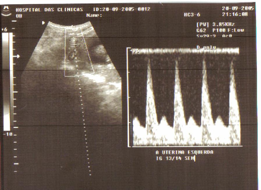 56 Figura 5 Dopplerfluxometria da artéria uterina materna com incisura protodiastólica. As setas verdes indicam as incisuras diastólicas.