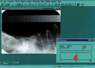 Medições radiográficas As imagens digitalizadas foram medidas por meio da ferramenta histograma, do programa Image Tool, versão 3.0 (UTHSCSA, USA).