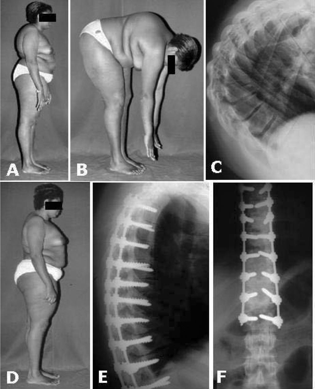 514 INTRODUÇÃO O aumento da cifose fisiológica ou a redução da lordose é denominado de hipercifose e pode ocorrer ao longo de toda a coluna vertebral, sendo mais frequente ao nível da coluna torácica