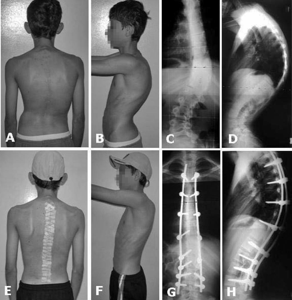 Aspectos clínico (E e F) e radiográfico (G e H) pós-operatório demonstrando a correção das deformidades.