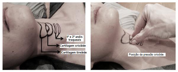 Aplicação da pressão cricoide Laringoscopia e intubação traqueal imediatamente após as fasciculações. O método clássico acima descrito não é mais seguido por completo.