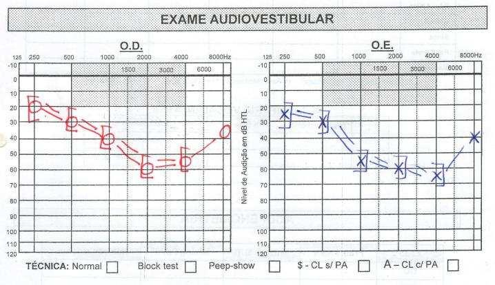 no desenvolvimento da linguagem. O exame audiométrico revelou surdez sensorioneural moderada a severa bilateral, com um audiograma de formato peculiar em barco (Figura 1).