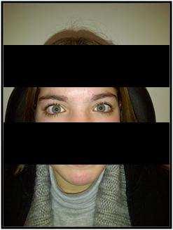 Figura 4: Fotografía clínica mostra um fácies atípico com heterochromia iridis e dystopia canthorum.