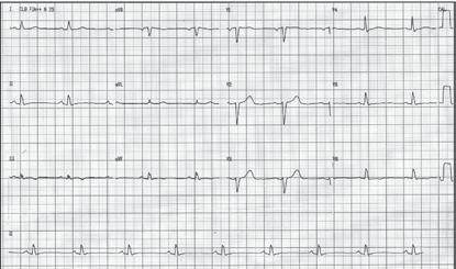 Ritmo sinusal com condução AV espontânea, diminuição das forças septais e alterações difusas da repolarização ventricular (FC em torno de 56 bpm). Figura 3.