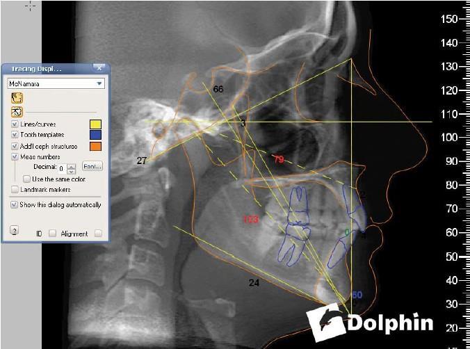 42 Figura 4 Software Dolphin Imaging 3D v. 11.5 (Dolphin Imaging & Management Solutions, Chatsworth, CA, EUA) 4.