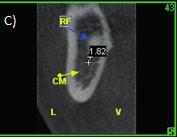 Foram utilizados arquivos digitais obtidos por um aparelho de TCFC i-cat (Xoran Technologies, Ann Arbor, Misch e Imaging Sciences Internacional, Hatfield, PA.