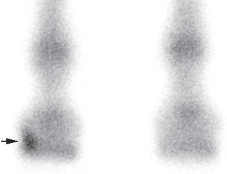 E D Figura 19: Projecção radiográfica dorsopalmar do membro anterior esquerdo com fractura dúbia (seta) da cartilagem lateral. (Imagem da autora).