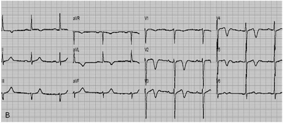 Figura 1 - Padrões eletrocardiográficos