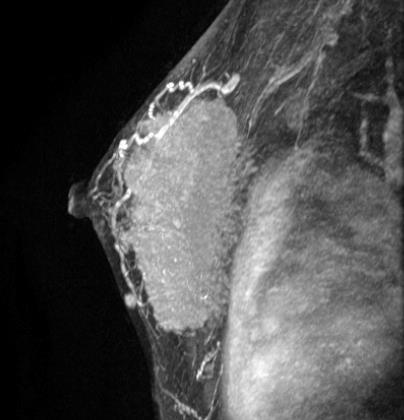 AP: carcinoma ductal invasor associado a