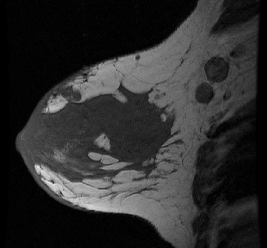 T1 STIR MIP subtração Fig. 2a Fig.