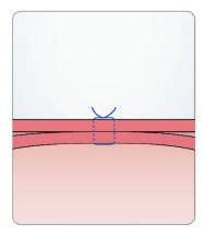 Kit de Gastrostomia Percutânea Endoscópica GMI por metodo de punção direta: A