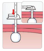 Característica: 100% silicone grau medico Alta biocompatibidade e