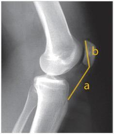 Figura 1: Índices de Insall-Salvati (A) e Caton-Deschamps (B) em radiografia lateral do joelho pré-operatória a: Comprimento do tendão patelar em milímetros; b: Maior eixo da patela em milímetros; c: