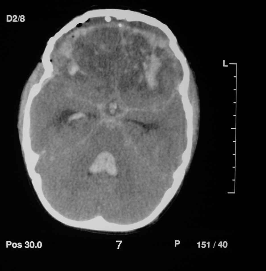 Contusão e hematoma intravenricular TC