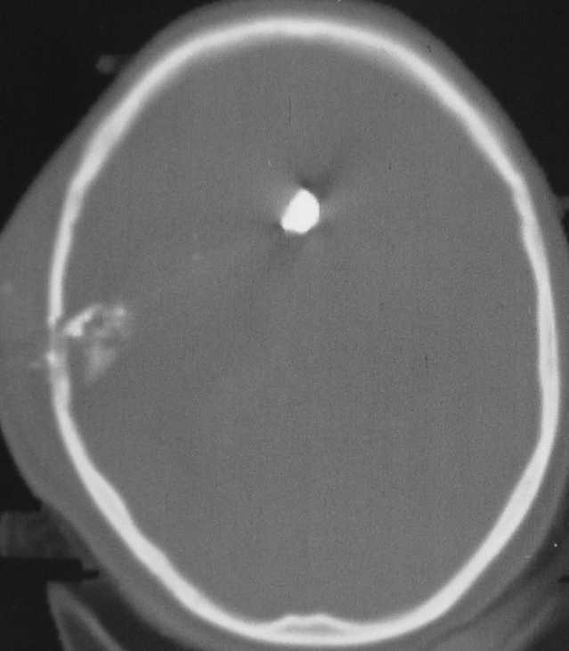 subcortical e CC